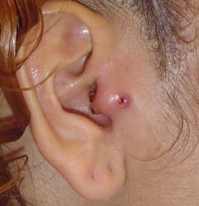 Tragus Piercing Infectie