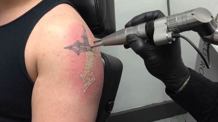 Laser Tattoo Verwijderen