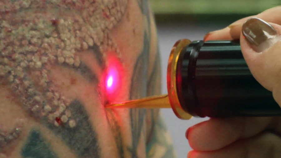 Kosten voor het verwijderen van tatoeages: hoeveel kost het verwijderen van lasertattoo's?