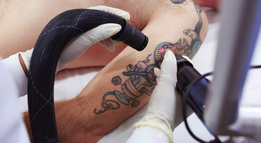 Laser Tattoo Removal: Alles wat u moet weten