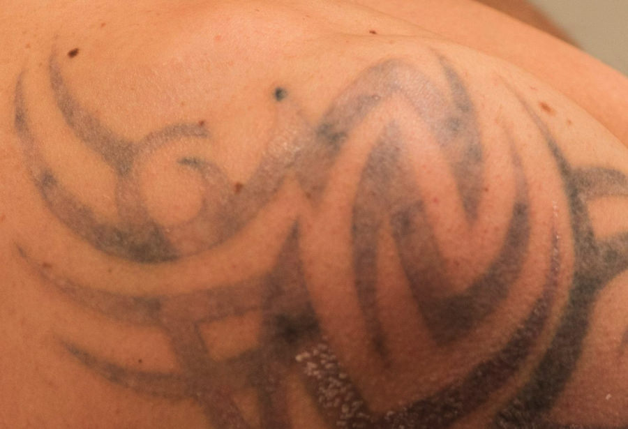 Waarom kiezen mensen ervoor om hun tatoeages te verwijderen?
