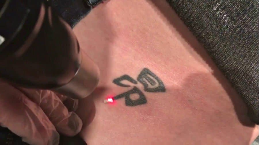 Hoe werkt het verwijderen van tatoeages?