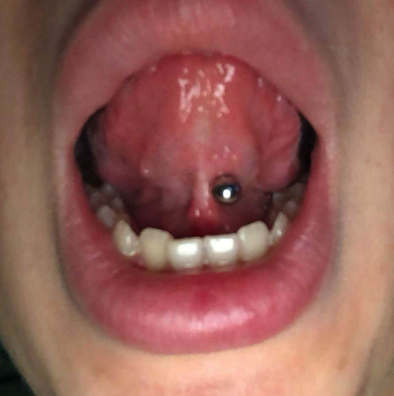 Waarom doet mijn tongpiercing pijn aan de onderkant?
