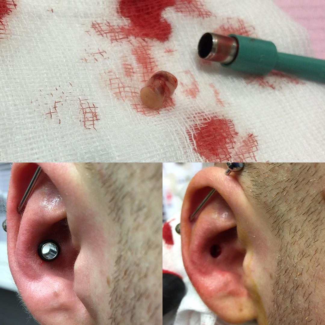 oor dermale punch procedure foto