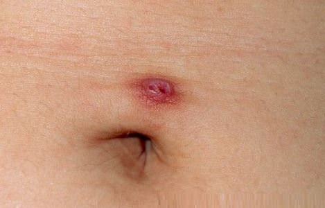 Navel piercing infectie