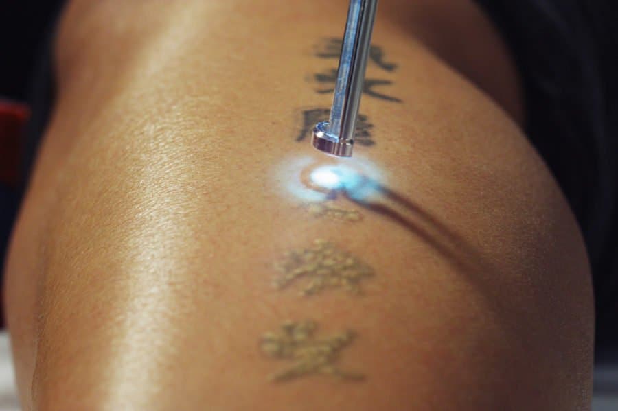 Laser Tattoo Removal Pijn: Hoeveel doet het pijn?