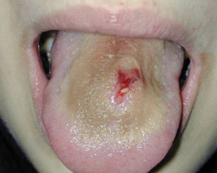Tong piercing infectie