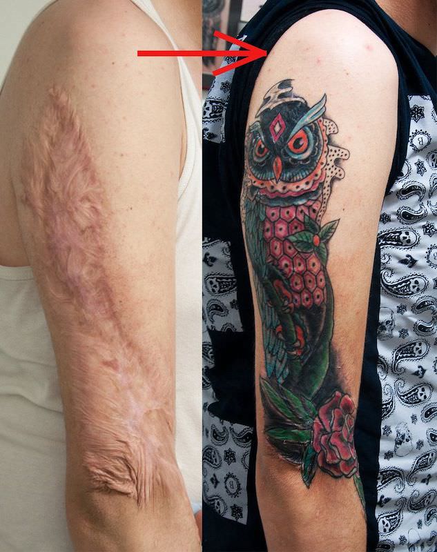 Kun je een tatoeage krijgen over een brandwondenlitteken?