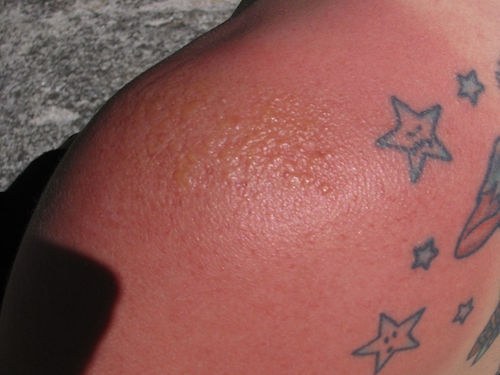 Zonnebrand op tatoeages: behandeling & preventie